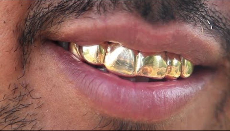 Des-dents-en-or.jpg
